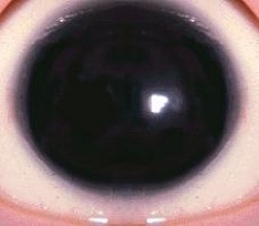 Eye with Aniridia